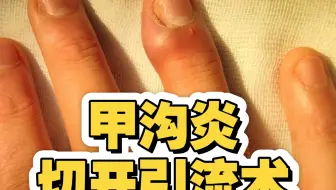 甲沟炎的切开引流术