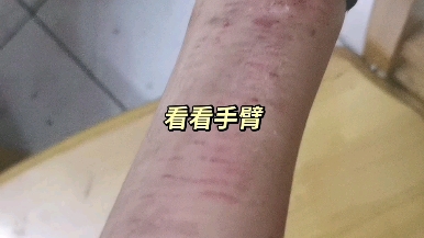 [图]吓人 变重度了 现在边缘人格障碍 自恋型人格障碍 还有伴精神病抑郁症重度 目前在学校乖乖吃药治疗哦 可怕的捏