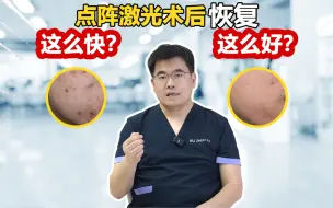 Download Video: 做完点阵激光，5天后就能见人，这是真的？