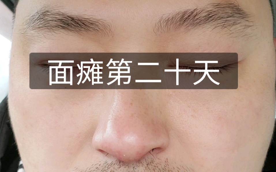 面瘫第二十天,针灸加吃药,逐步康复中,笑起来依然歪嘴,加油!
