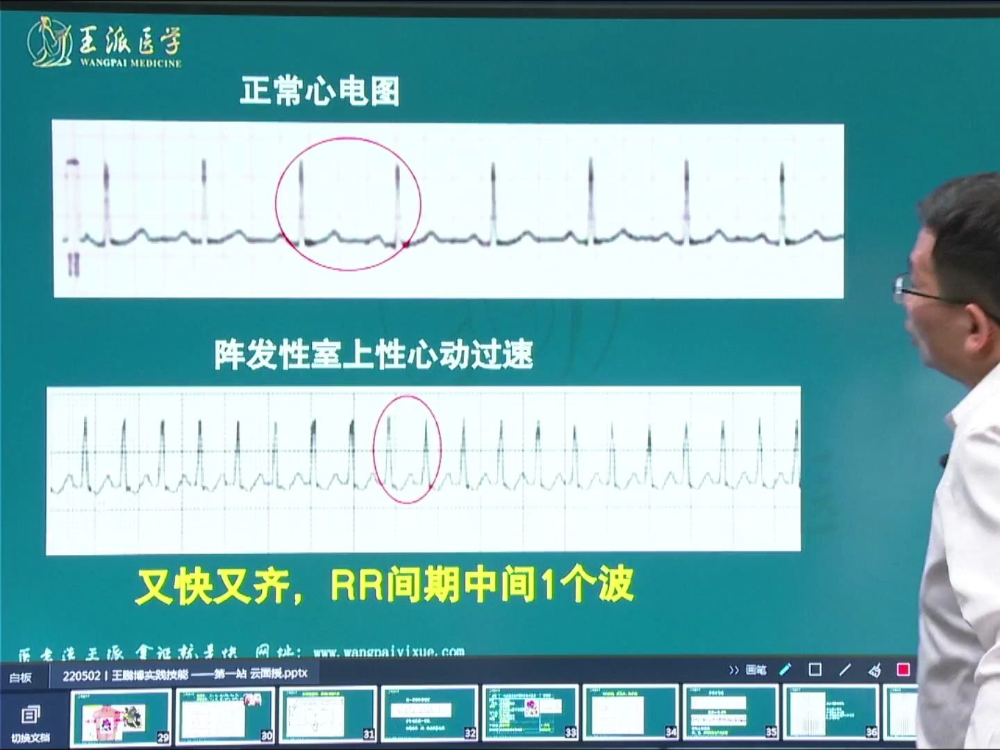 阵发性房性心动过速图片